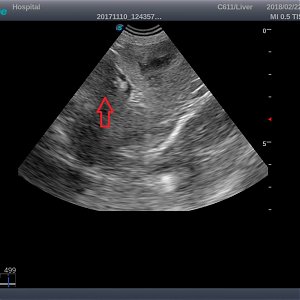 Cushing's syndrome